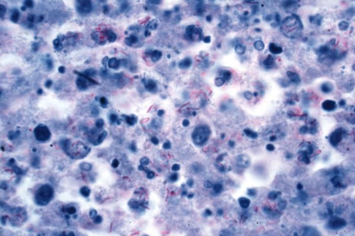 Uzroci i glavni znakovi plućne tuberkuloze kod odraslih osoba