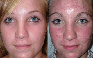 kako izliječiti akne na licu